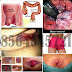 Penyebab, Gejala dan Pengobatan Wasir (Hemoroid) thumbnail