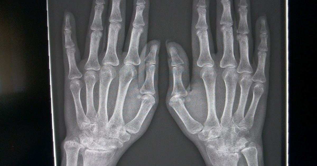Rheumatologe Rheumatoid Arthritis Radiographic Progression