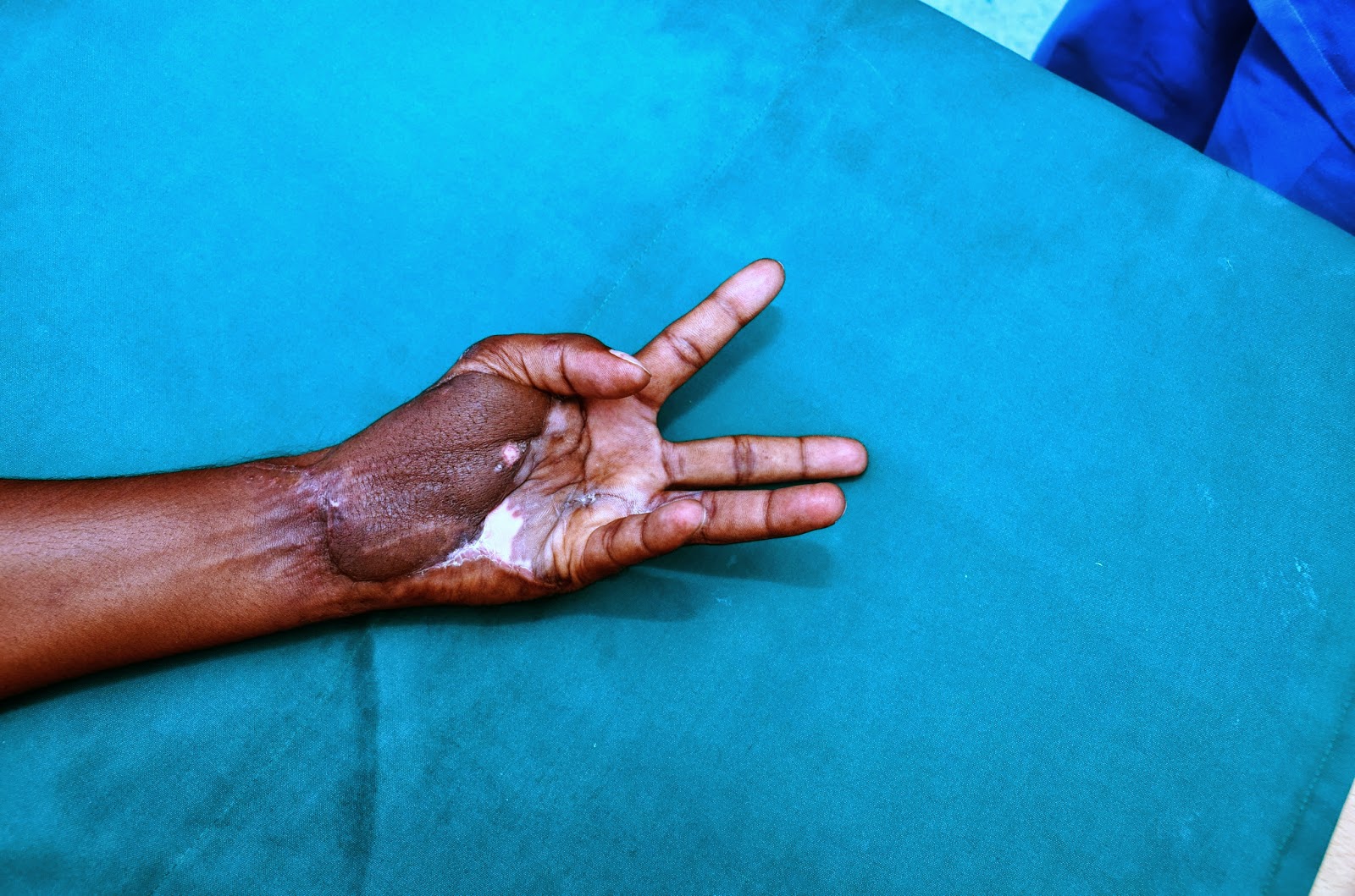 CRUSH INJURIES OF HAND AND UPPER LIMB INJURIES PALMAR DEGLOVING INJURY