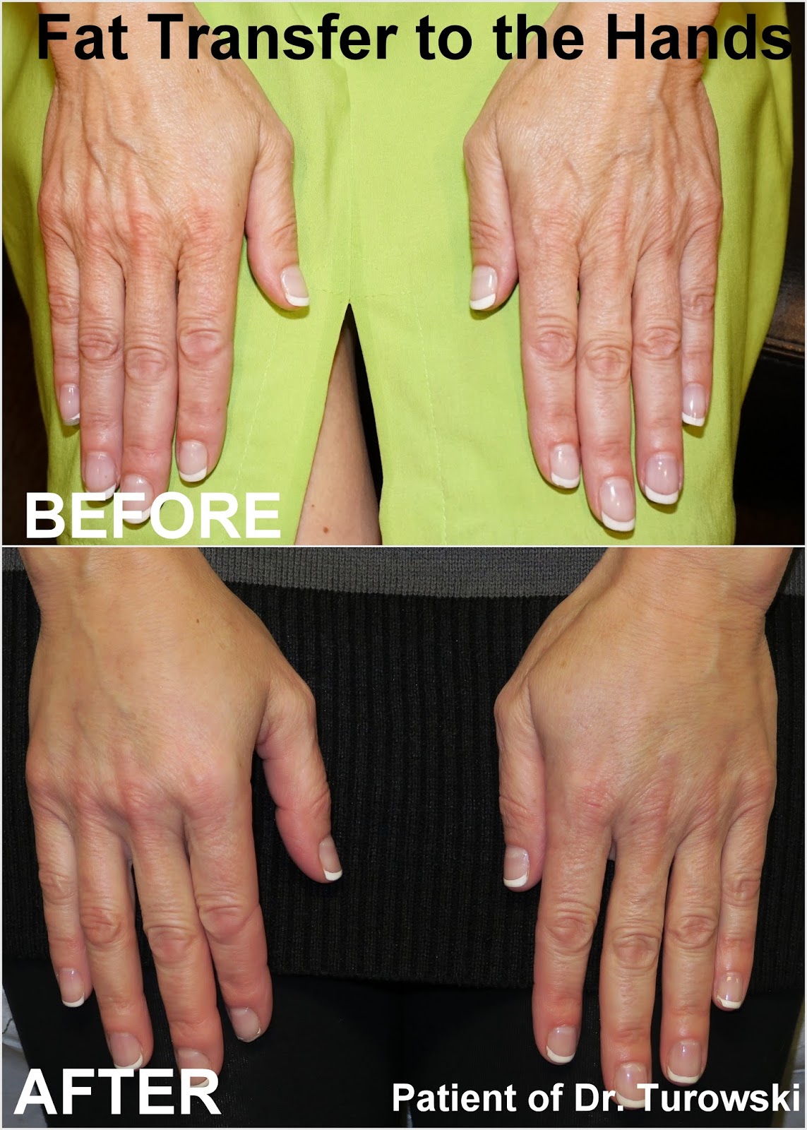 New Horizons Plastic Surgery Fat Transfer to Hands