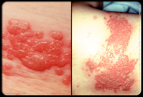 stages of poison ivy rash pictures. minor poison ivy rashes. minor