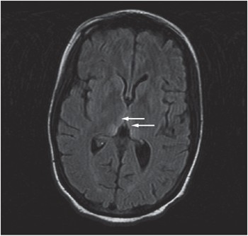 wernicke encephalopathy