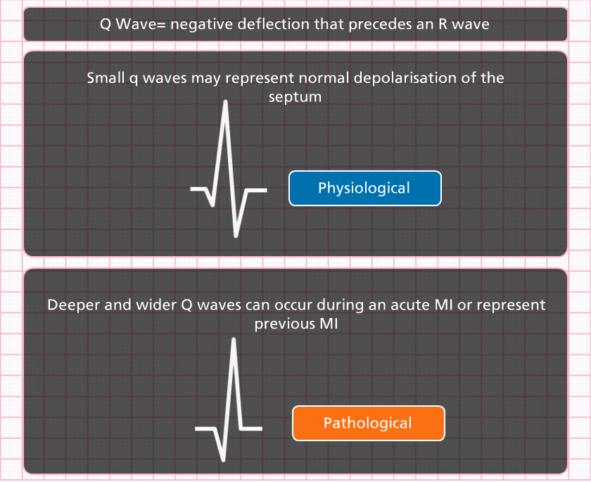Pathological q waves   or not?   ecg class