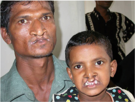 zihin engelinin sebepleri blogger