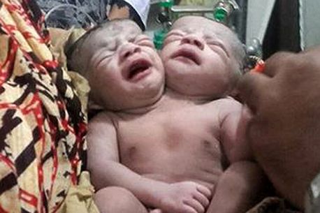 A-Bangladeshi-baby-girl-born-with-two-heads.jpg