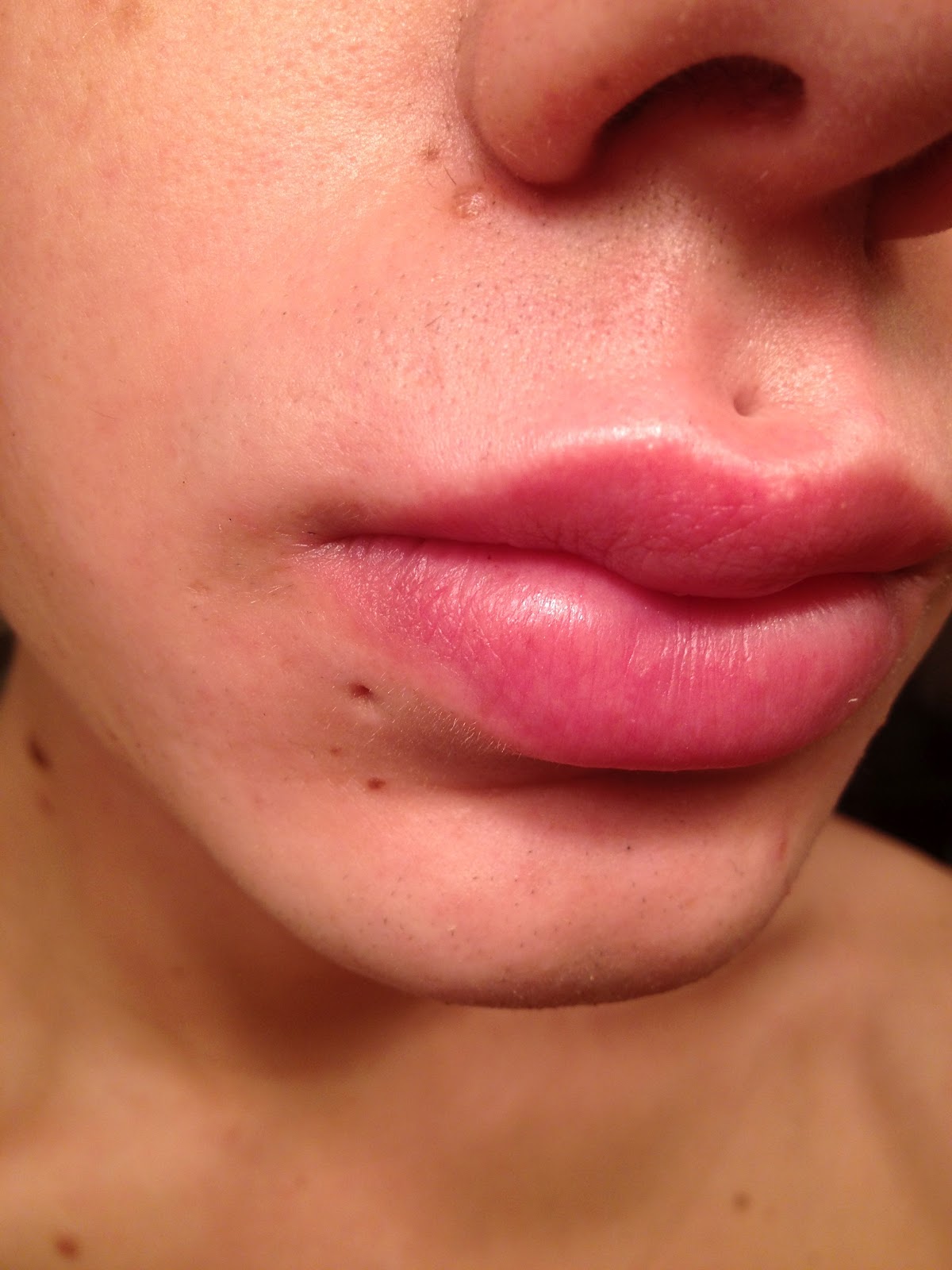 medusa piercing ärr medusa piercing ärr