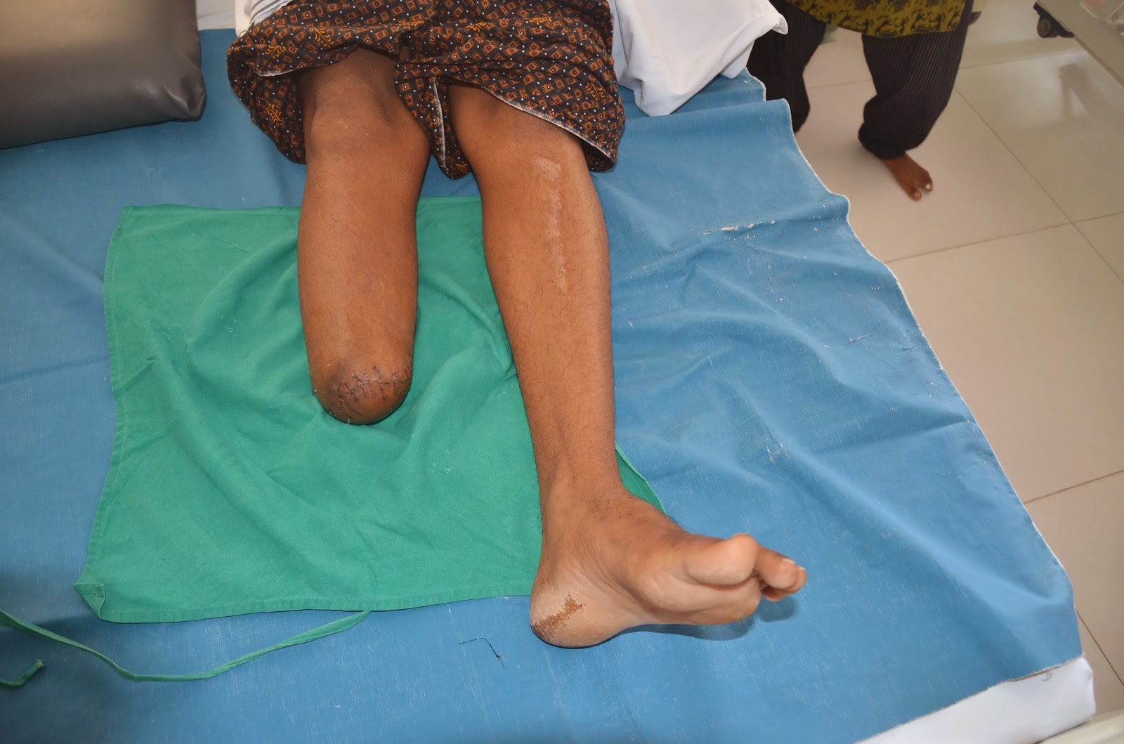 CRUSH INJURY FOOT WITH BONE LOSS AND NERVE INJURY BELOW KNEE