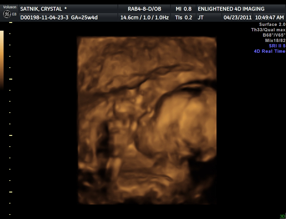 3d ultrasound pictures at 26 weeks. 3D Ultrasound - 26 weeks