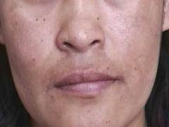 La prevención de las manchas de pigmento