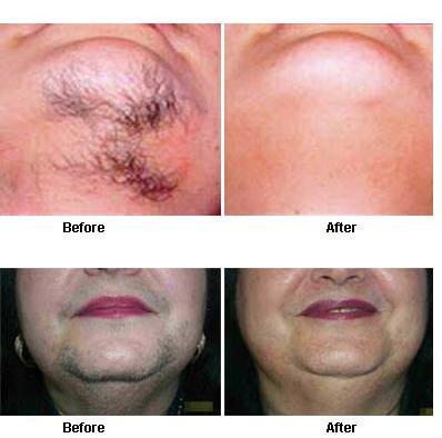 Thanaka Powder Grade Groz And Kusumba Oil Hair Remover Natural