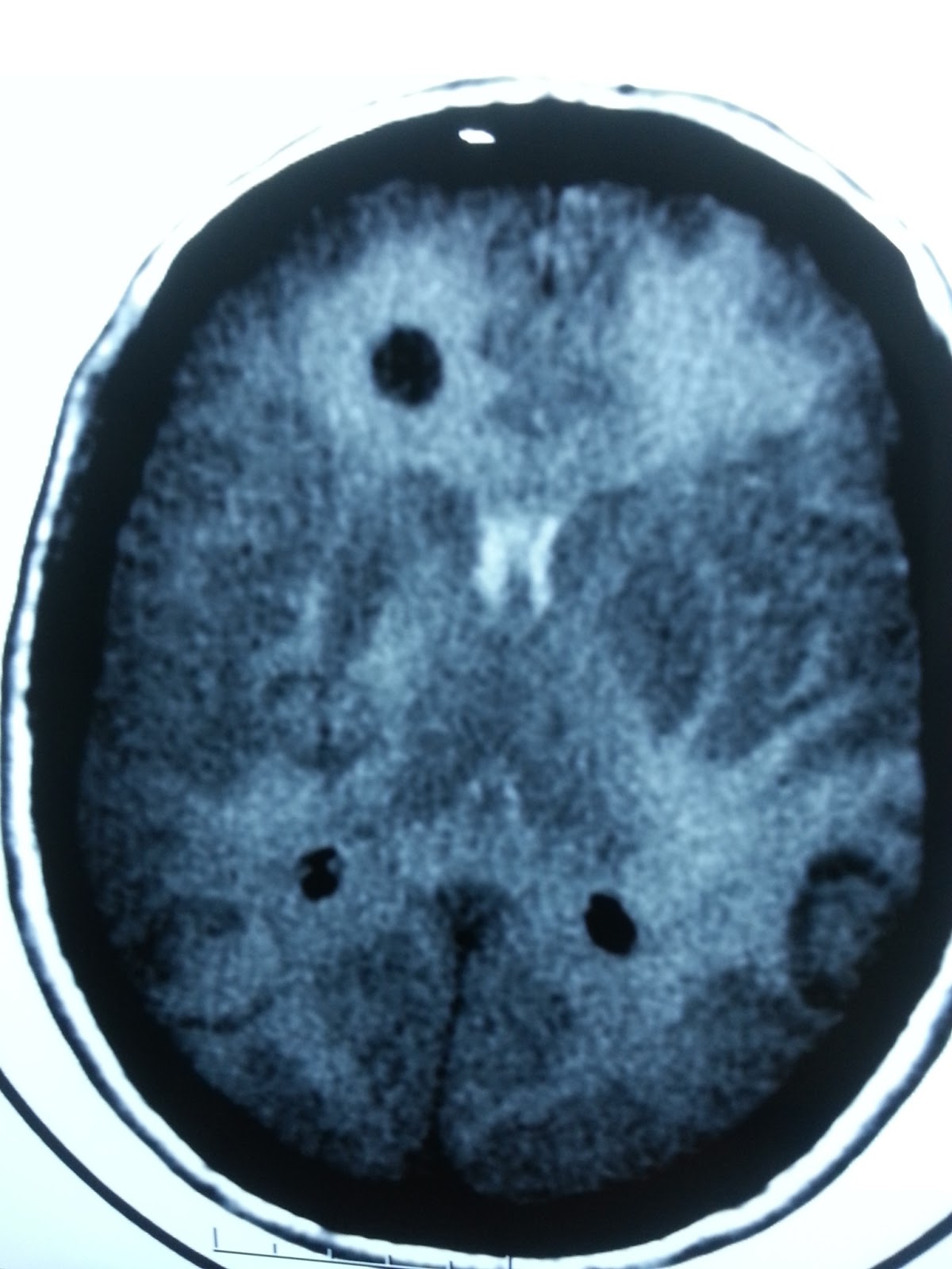 Iperossaluria Primaria