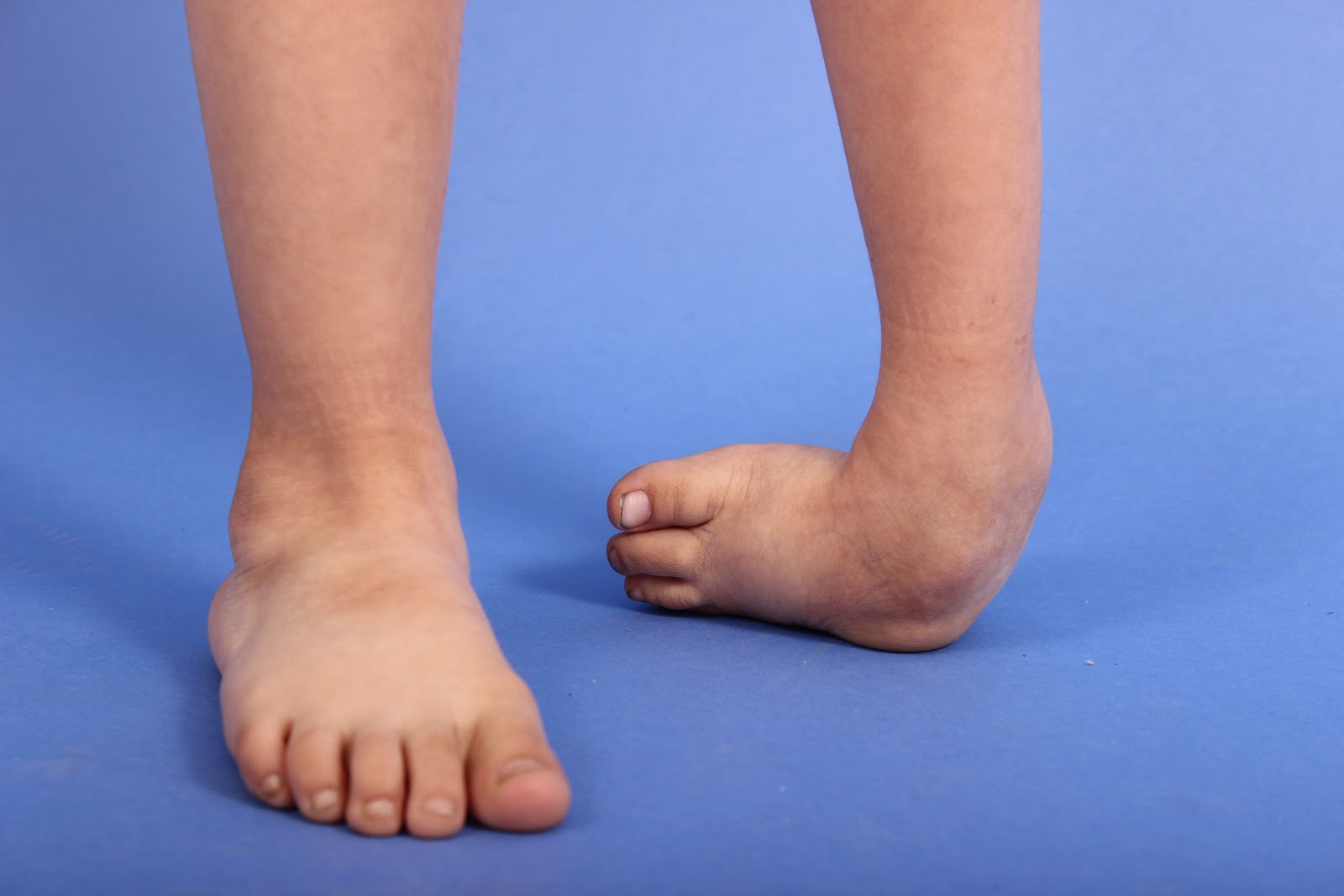 Ortopedia Pediátrica para Padres de Familia Pie equino varo aducto