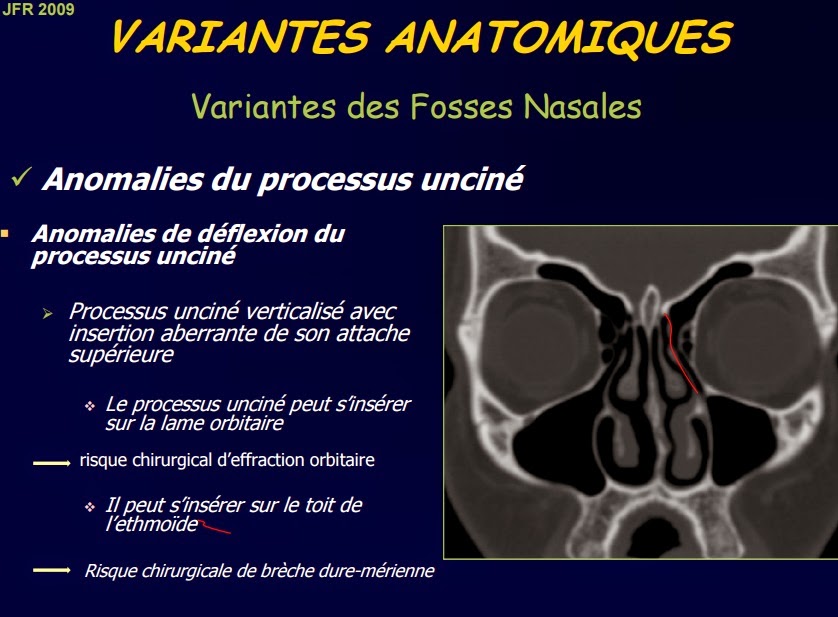 Ma bibliothèque en Imagerie Médicale VARIANTES ANATOMIQUES DES SINUS