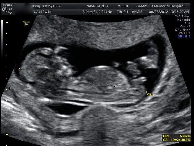 The Pregnancy – Or there and back again..: Nuchal Translucency Scan! 12