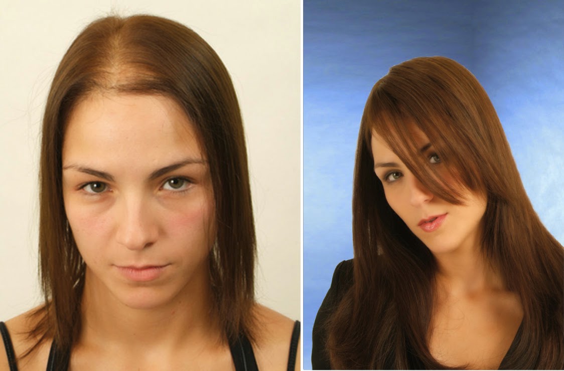 Hair Female loss treatments forecast to wear for summer in 2019 Hair Female loss treatments forecasting to wear for spring in 2019