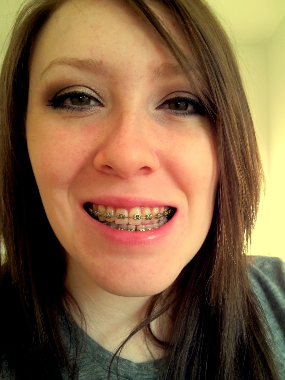 bite jaw under surgery braces teeth well months