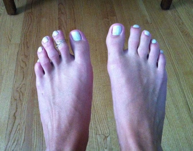 My Toe Shortening Surgery 4 Years Since Surgery!