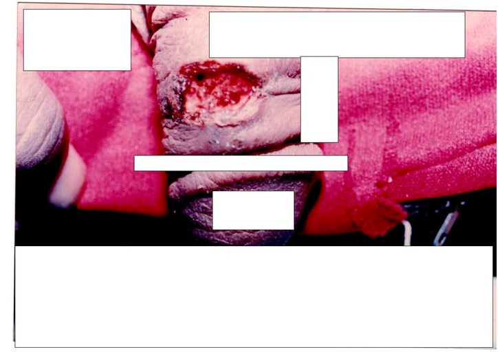 thesis on warts Hpv essays: over 180,000 hpv essays, hpv term papers, hpv research paper, book reports 184 990 essays, term and research papers available for unlimited access. thesis on warts Hpv essays: over 180,000 hpv essays, hpv term papers, hpv research paper, book reports 184 990 essays, term and research papers available for unlimited access.