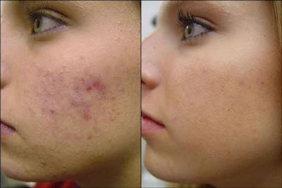 Natural Ways to Remove Acne | Healthy Logica Natural Ways to Remove Acne | Healthy Logica