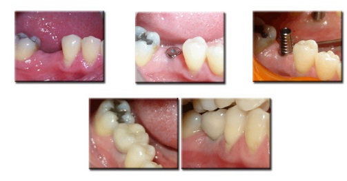 Steps in Implant Procedures