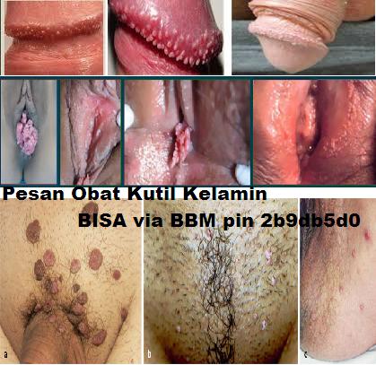 Ciri Gejala Kutil Kelamin Condyloma Acuminata Ciri Gejala Kutil Kelamin Condyloma Acuminata