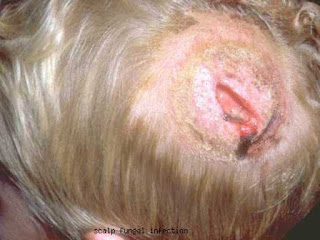 scalp ringworm infection