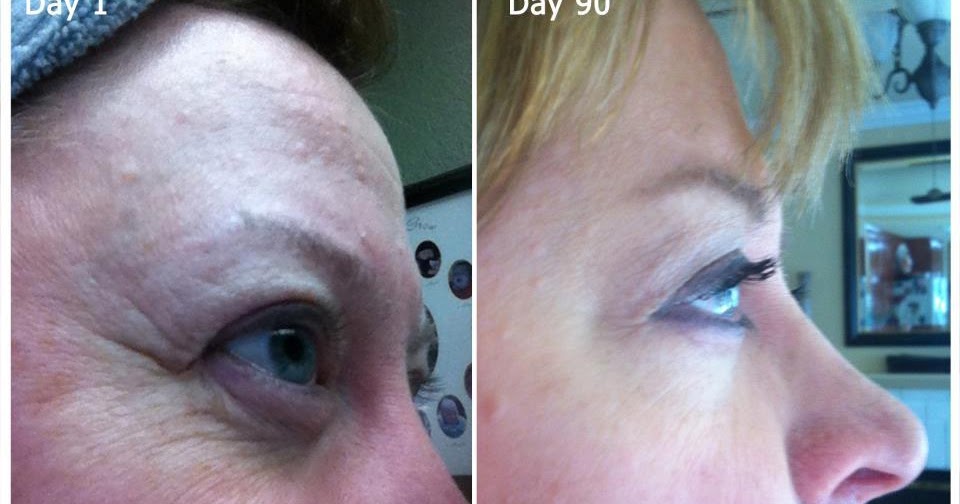 Nerium AD Results Before &amp; After What Works For Under Eye