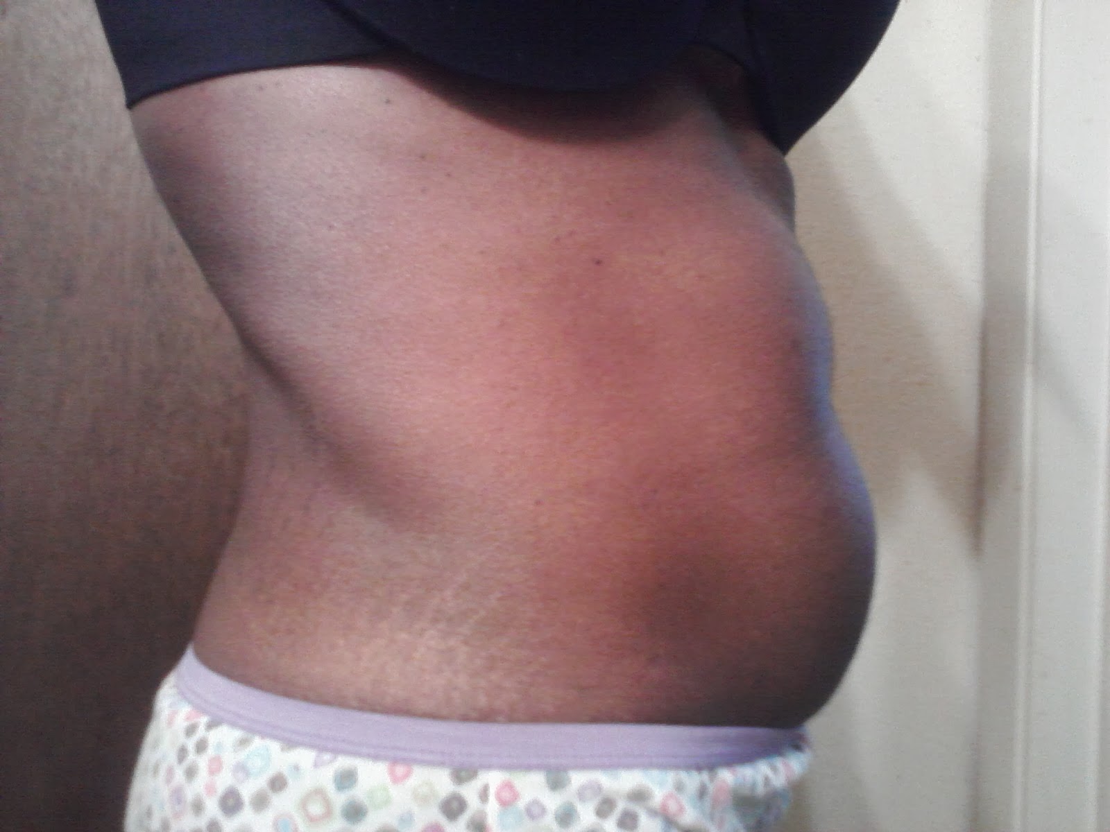 how i am shrinking my fibroids acupuncture shrinks fibroids lowers