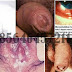 Obat Gonore Kencing Nanah Selain Cipro (Ciprofloxacin) thumbnail