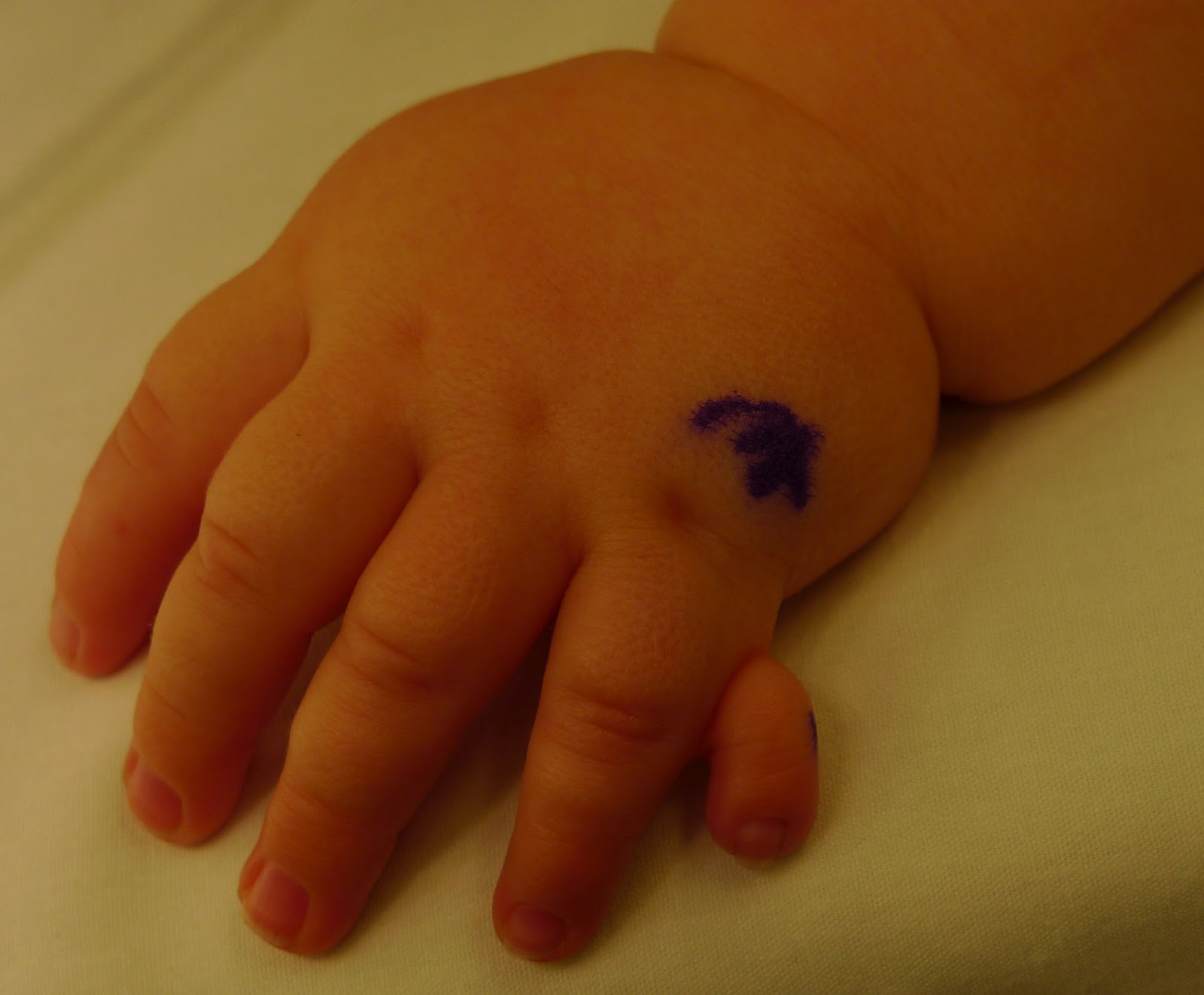 "Simple" Extra Digits Congenital Hand and Arm Differences