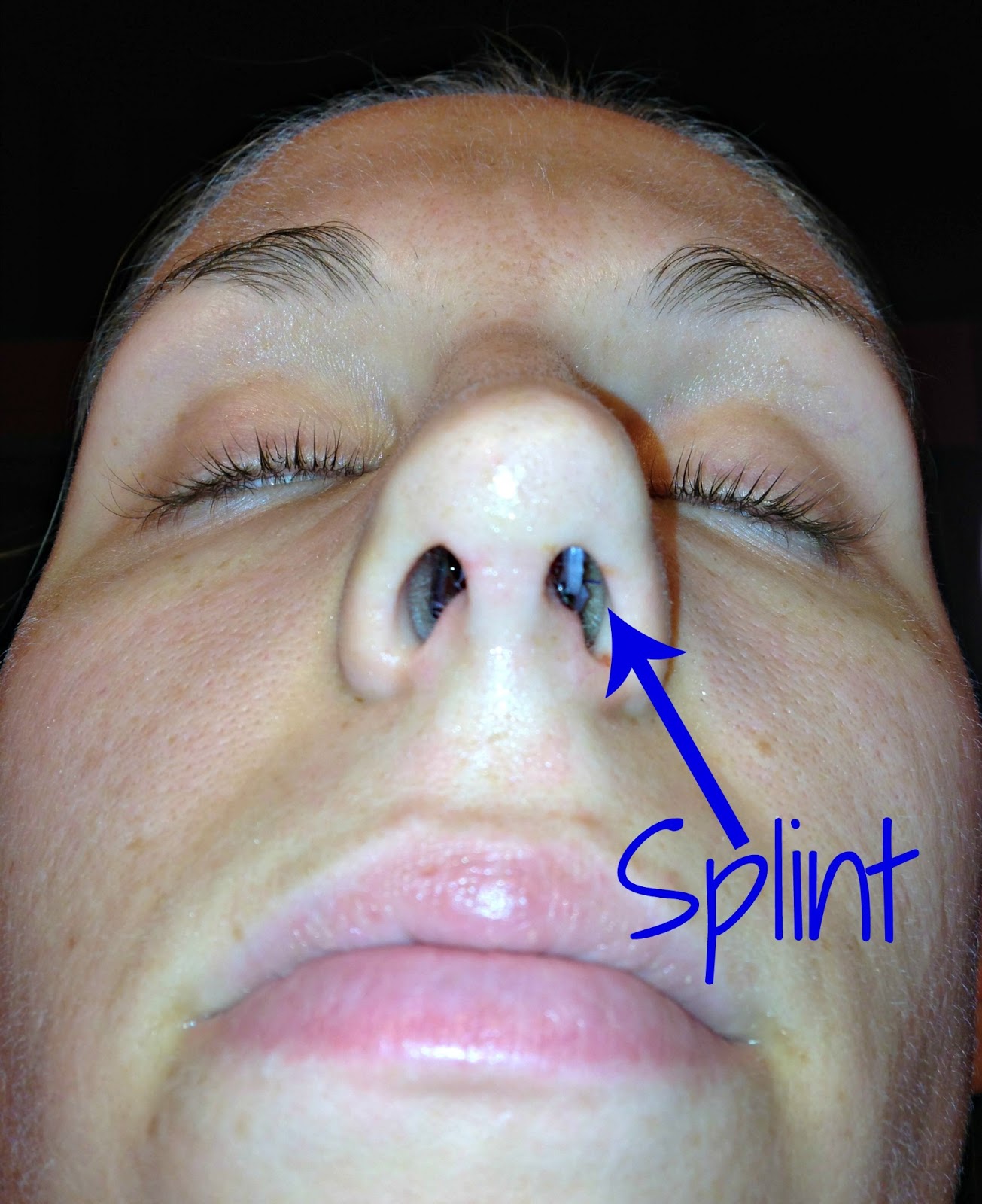 Stitches In Mouth Dissolve at Davis Gann blog