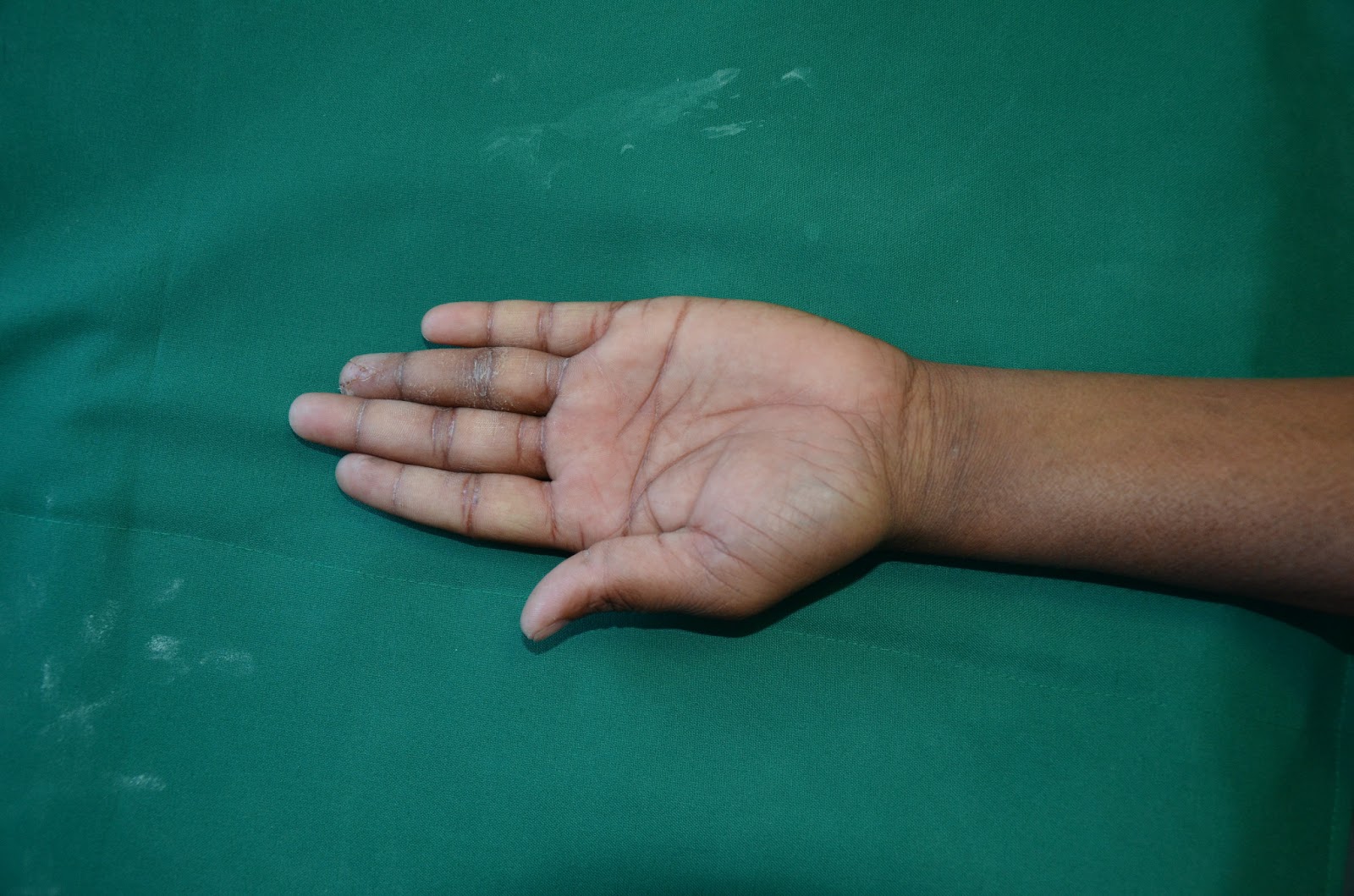 RING FINGER TIP INJURY VY FLAP COVERAGE CRUSH INJURIES