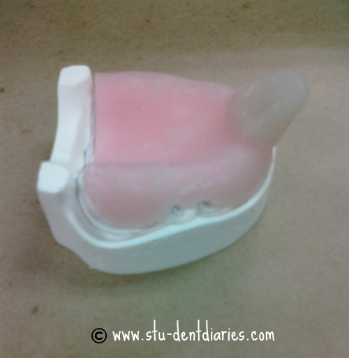 StuDENT Diaries Custom Tray, Record Base and Wax Rim