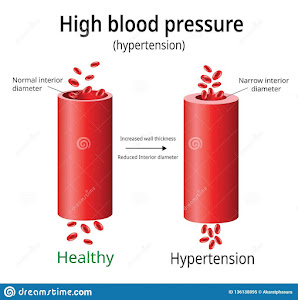 21 Days High Blood Pressure Solution