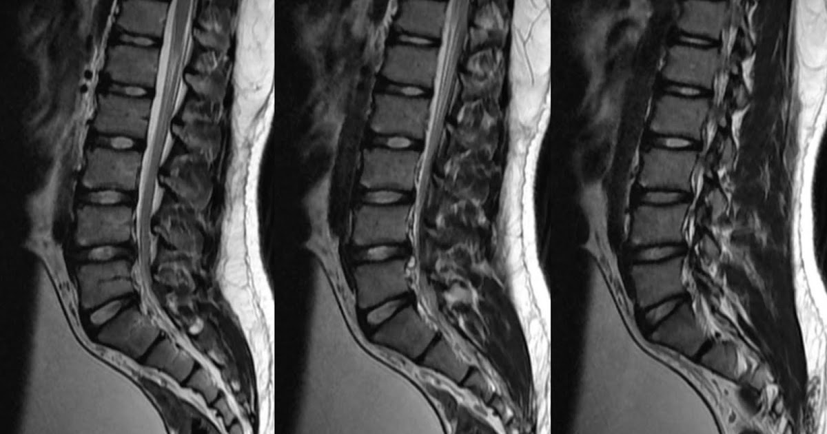 Neuroradiology Cases Discal Cyst MRI Lumbar Spine