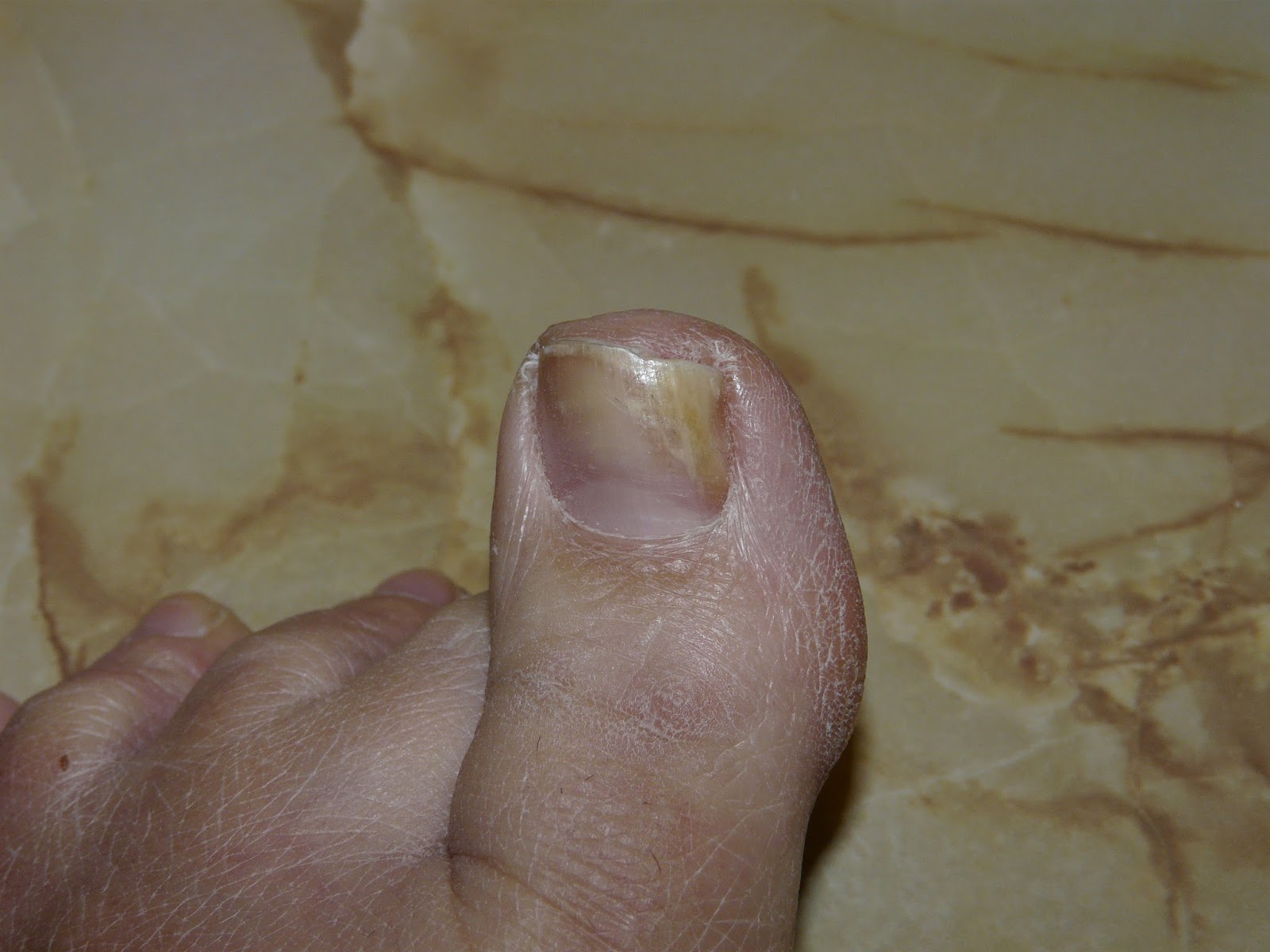 The "Secret" is Gratitude Curing Toenail Fungus Using Hydrogen Peroxide