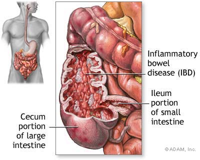 Crohn’s Disease Picture
