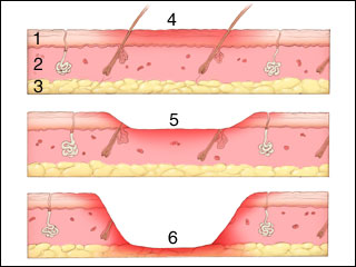 the different degree of burns Third-degree burns (full thickness burns) or steam come in contact with skin as a result of many different circumstances, including house fires. the different degree of burns Third-degree burns (full thickness burns) or steam come in contact with skin as a result of many different circumstances, including house fires.