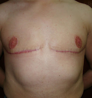 Outcome after radical bilateral mastectomy