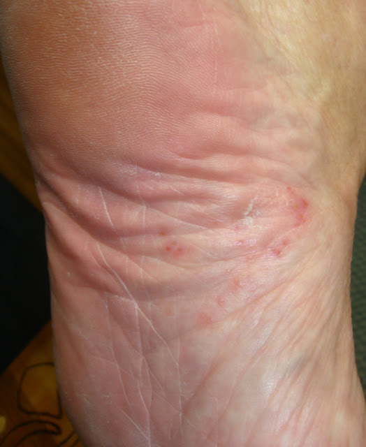 Consultations in Dermatology Tinea pedis vesicular