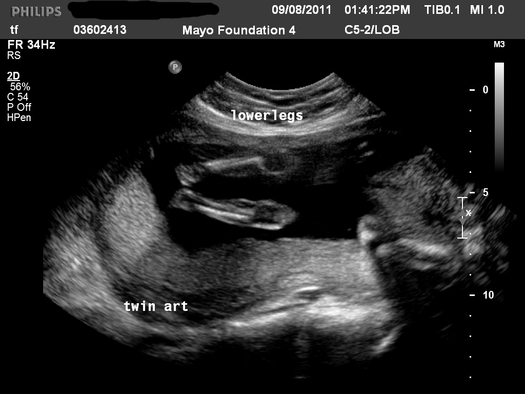 A baby for you Anatomy Ultrasound/19 weeks and 2 days/a funny story