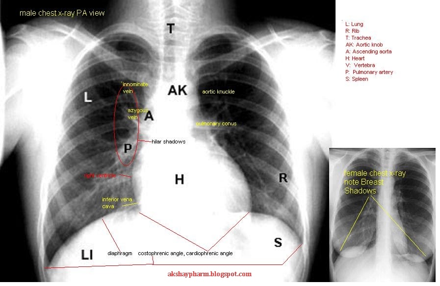 flesh eating bacteria Learn Chest Xray in 5 minutes