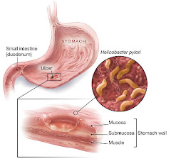 Waa maxay helicobacter pylori