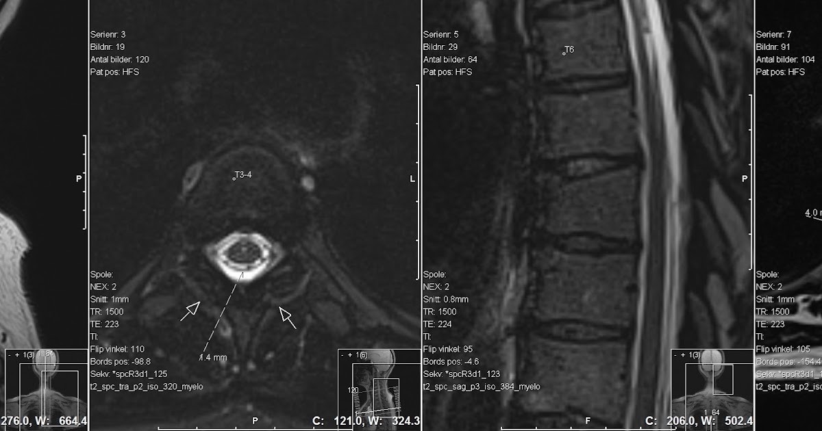 ct myelogram vs mri for csf leak
