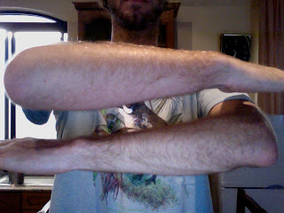 Swollen Arm Due to Tsetse Fly Bites
