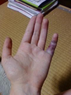 spricka i fingret symptom spricka i fingret symptom