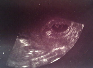 .Our Baby At 5 Weeks.