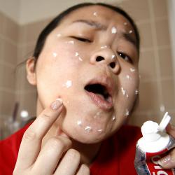imgname-toothpaste_for_pimples-50226711-images-2420480843_29cdd17150.jpg