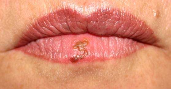 herpes symptoms in women. +genital+women Herpes