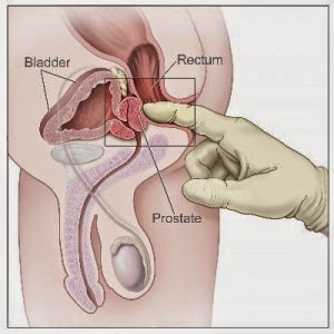obat kanker Prostat tradisional stadium 1, obat kanker prostat, pengobatan kanker prostat